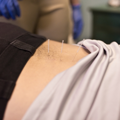 Dry-needling-River-Ridge-Chiropractic-River-Ridge-LA