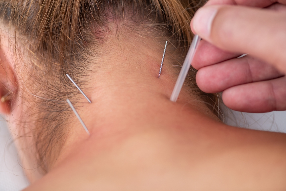 Dry-Needling-vs.-Traditional-Chiropractic-Whats-the-Difference-legacy-chiropractor-chiropractor-metairie